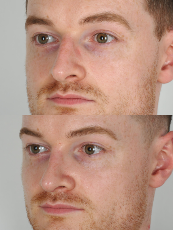 Rinoplastia Ultrasónica antes y después