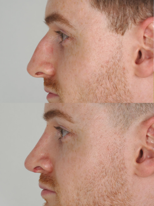 Rinoplastia Ultrasónica antes y después