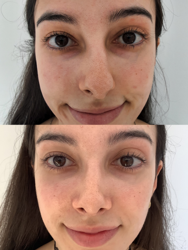 Rinoplastia Ultrasónica antes y después