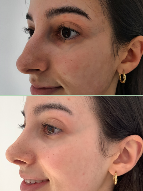 Rinoplastia Ultrasónica antes y después