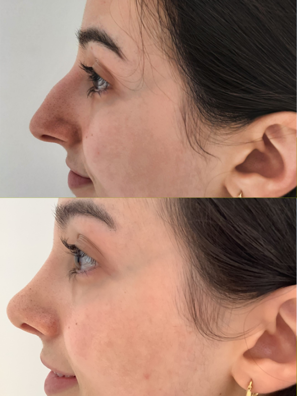 Rinoplastia Ultrasónica antes y después