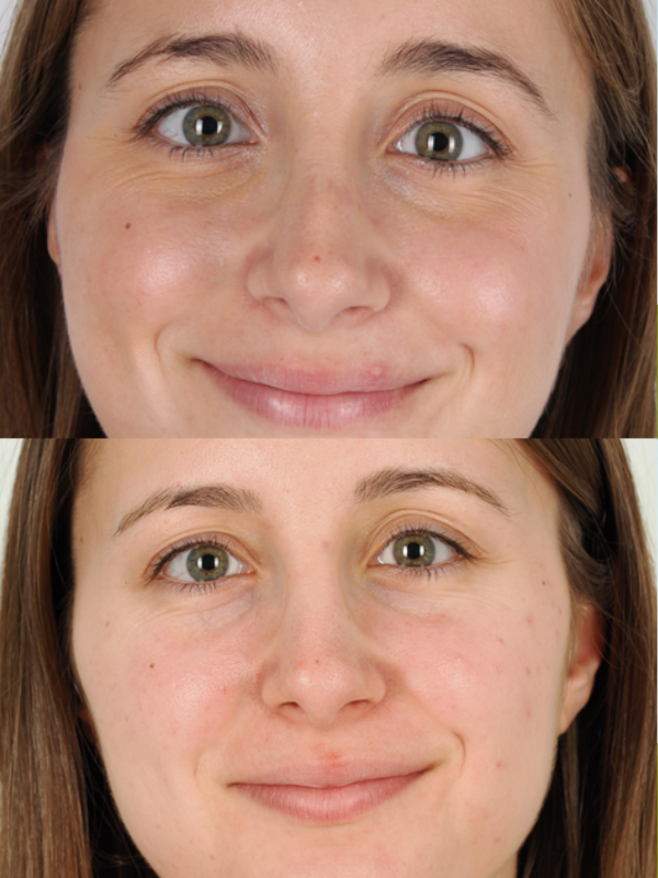 Rinoplastia Ultrasónica antes y después