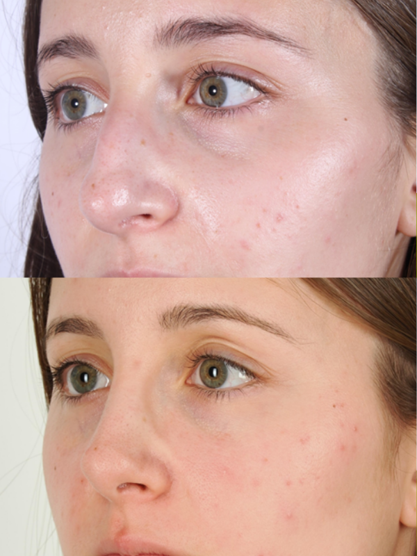 Rinoplastia Ultrasónica antes y después