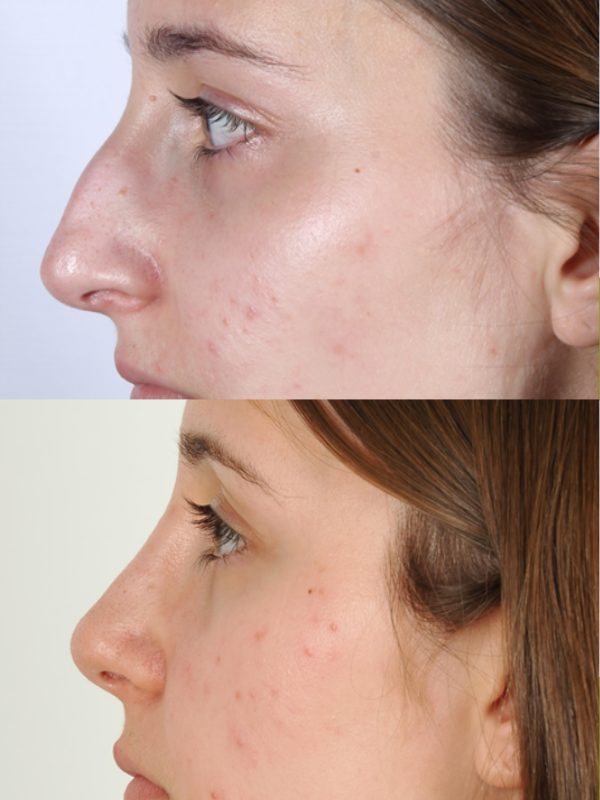 Rinoplastia Ultrasónica antes y después