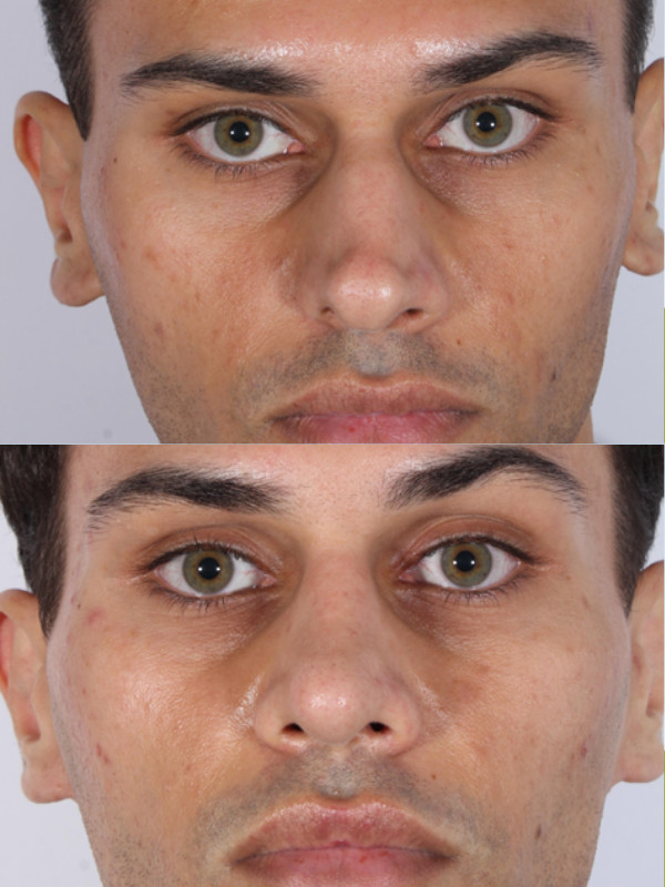 Rinoplastia Ultrasónica antes y después