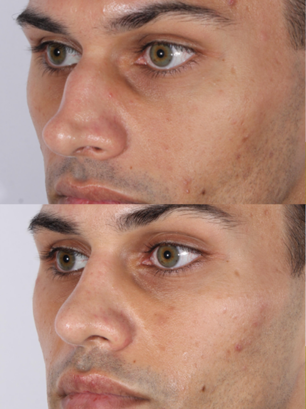 Rinoplastia Ultrasónica antes y después