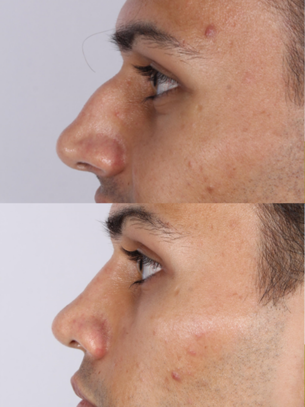 Rinoplastia Ultrasónica antes y después