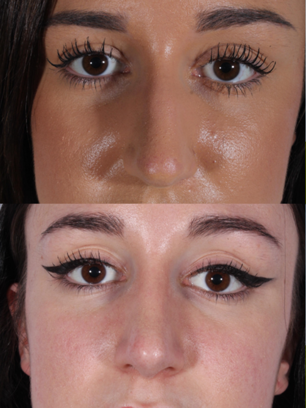 Rinoplastia Ultrasónica antes y después