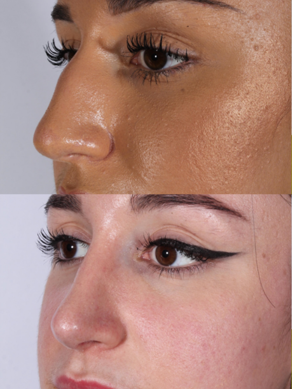 Rinoplastia Ultrasónica antes y después