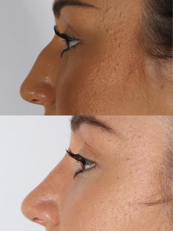 Rinoplastia Ultrasónica antes y después