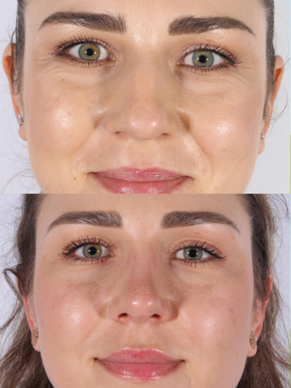 Rinoplastia Ultrasónica antes y después