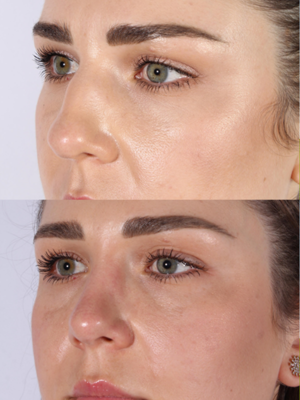 Rinoplastia Ultrasónica antes y después