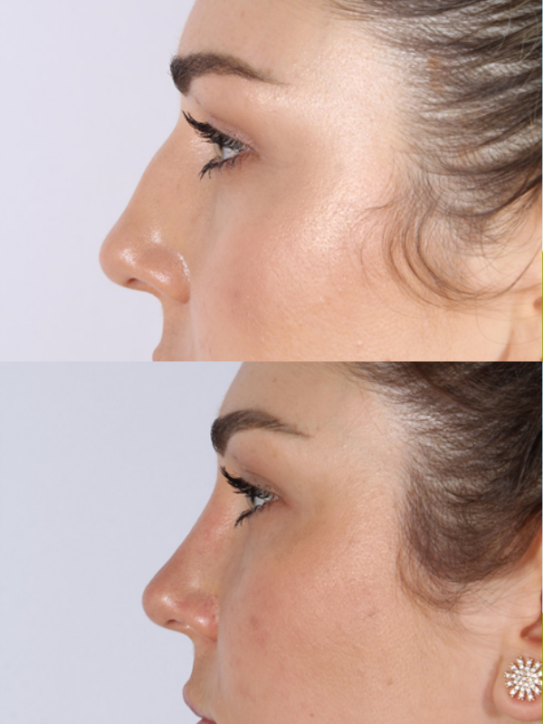 Rinoplastia Ultrasónica antes y después