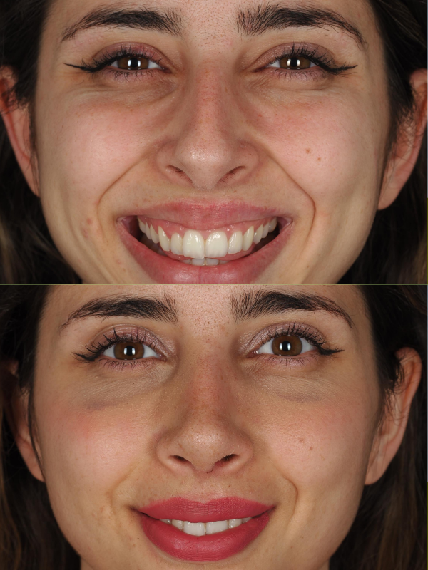 Rinoplastia Ultrasónica antes y después