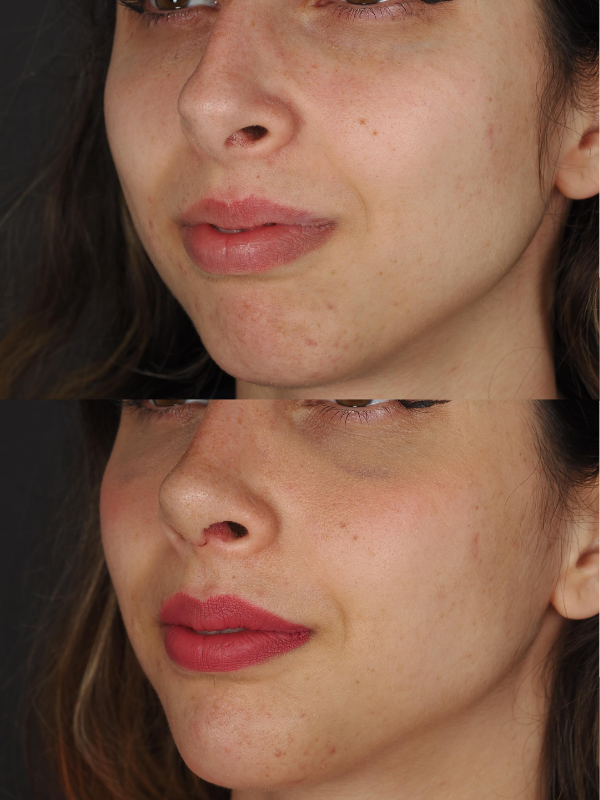 Rinoplastia Ultrasónica antes y después