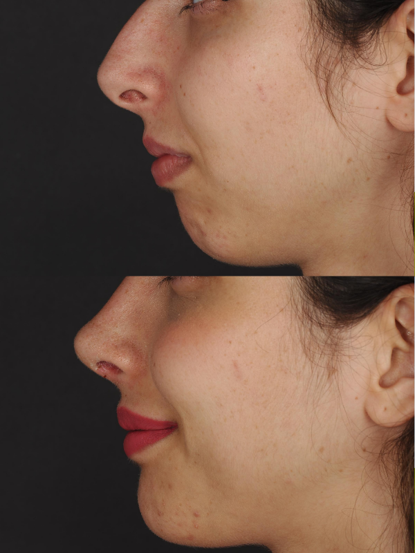 Rinoplastia Ultrasónica antes y después