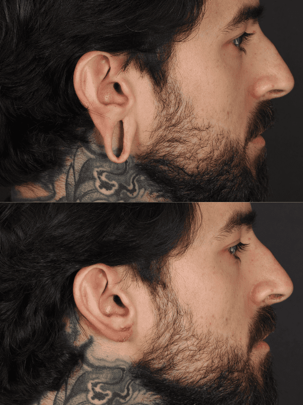 Lobuloplastia antes y después