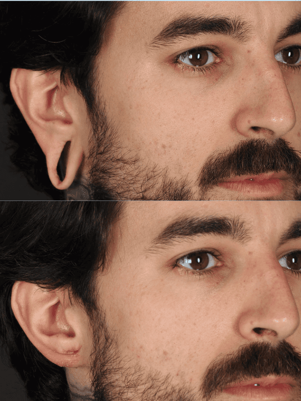 Lobuloplastia antes y después