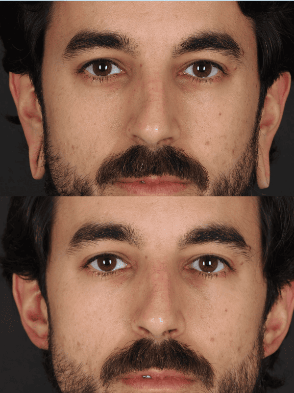 Lobuloplastia antes y después
