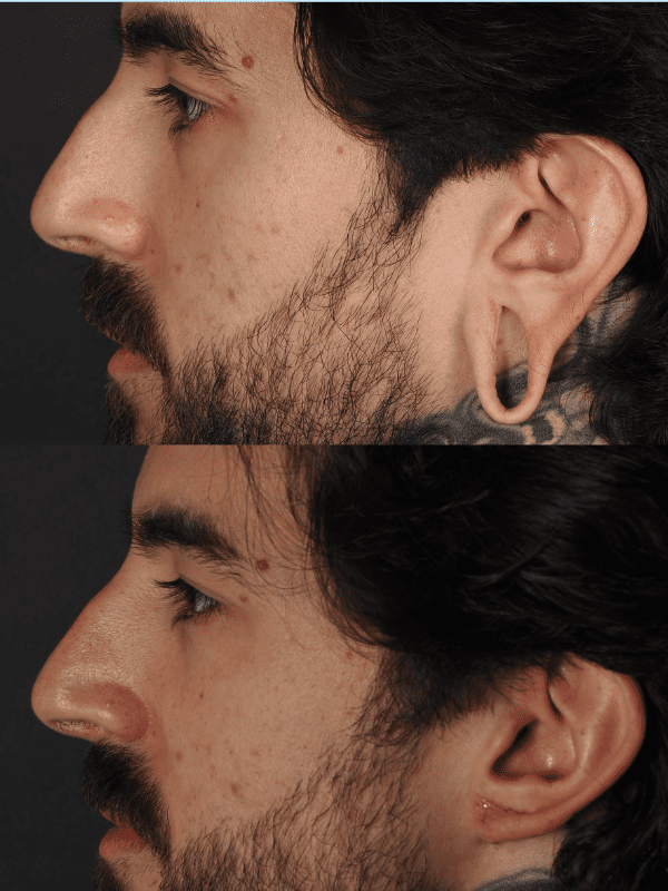 Lobuloplastia antes y después