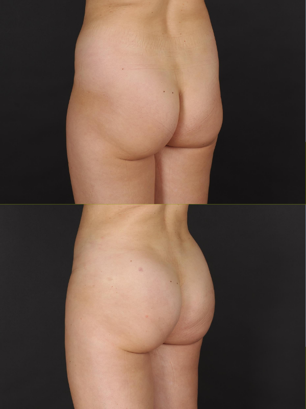 Aumento de Glúteos con Lipotransferencia antes y después