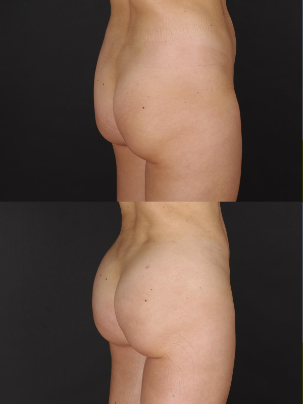 Aumento de Glúteos con Lipotransferencia antes y después