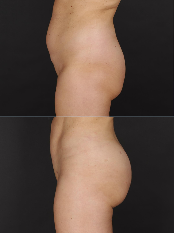 Aumento de Glúteos con Lipotransferencia antes y después
