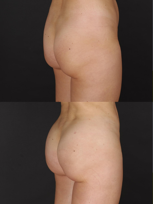 Aumento de Glúteos con Lipotransferencia antes y después