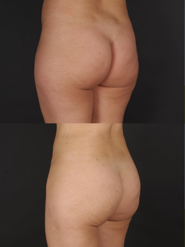 Aumento de Glúteos con Lipotransferencia antes y después