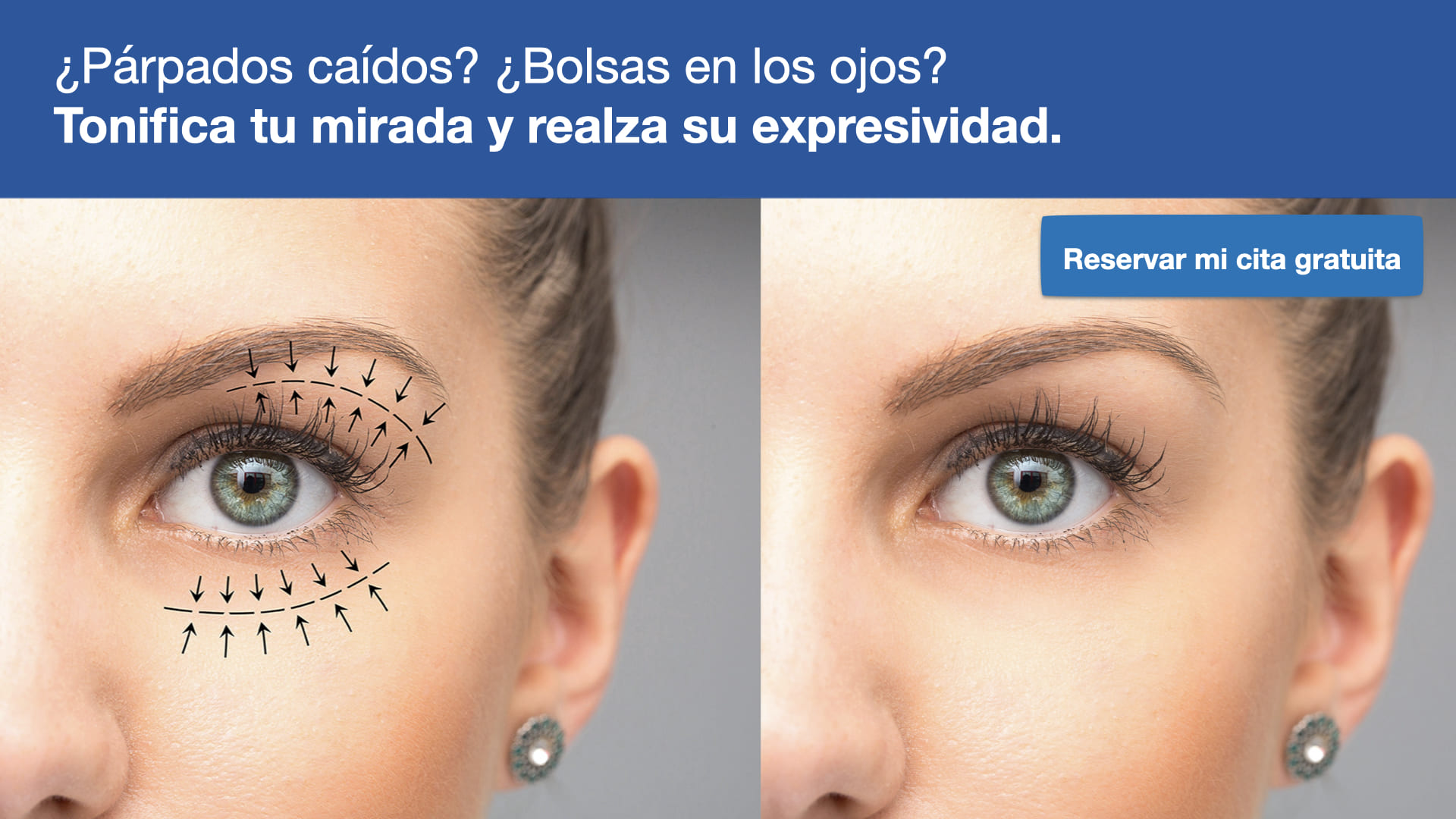 Blefaroplastia