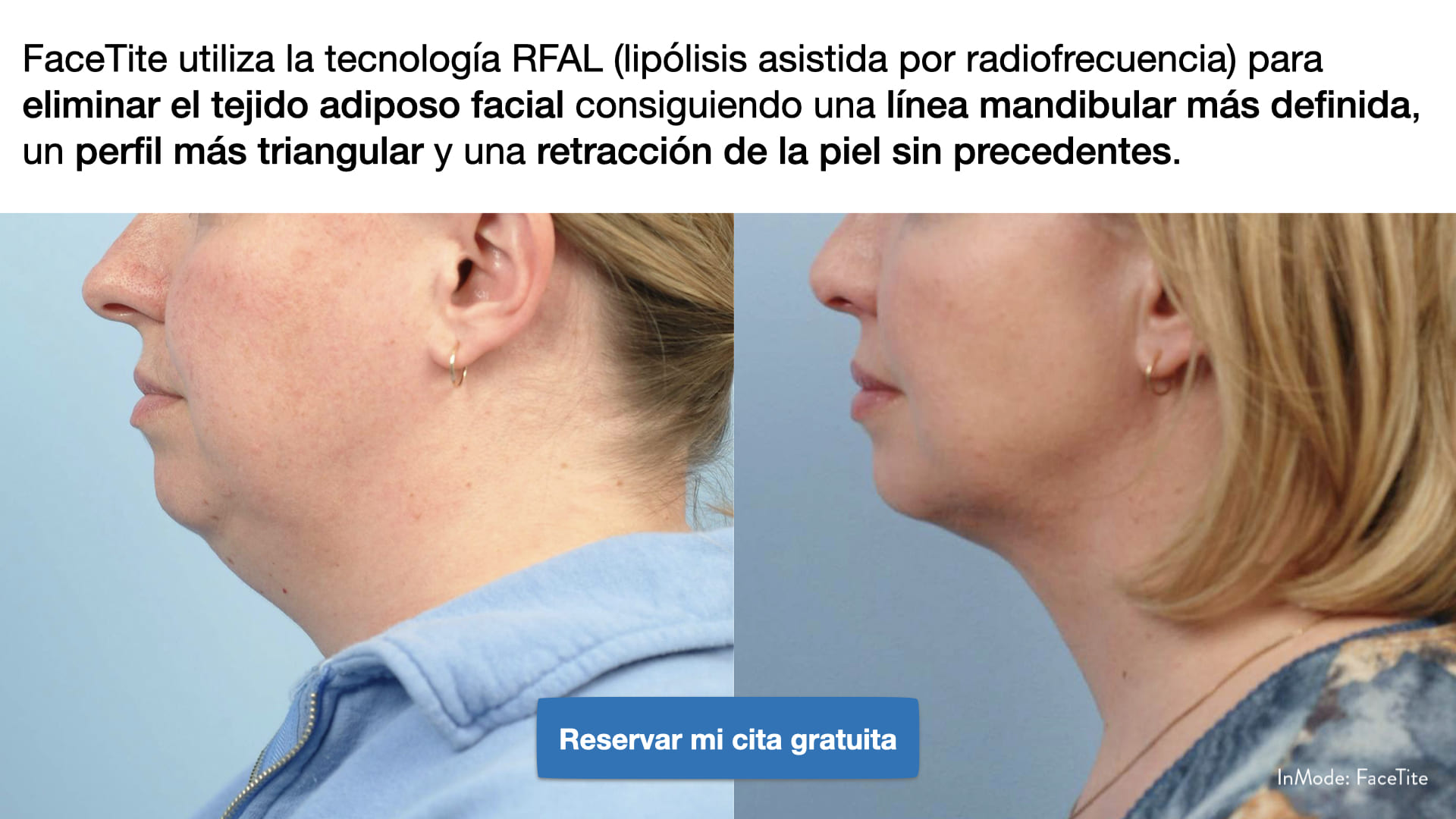 Eliminación de Papada