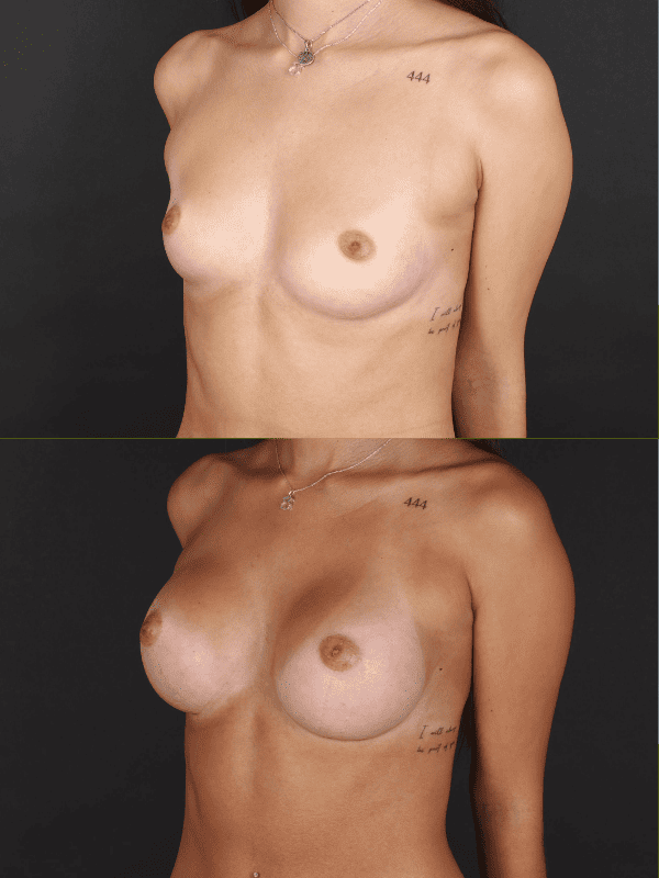 Minimal Scar