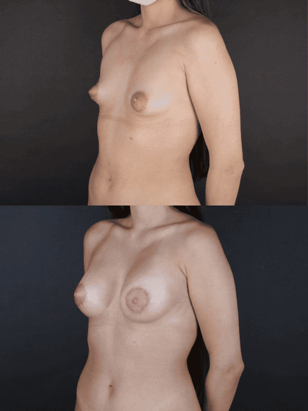 Minimal Scar