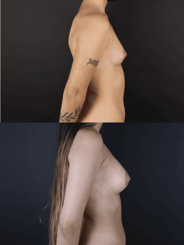 Minimal Scar