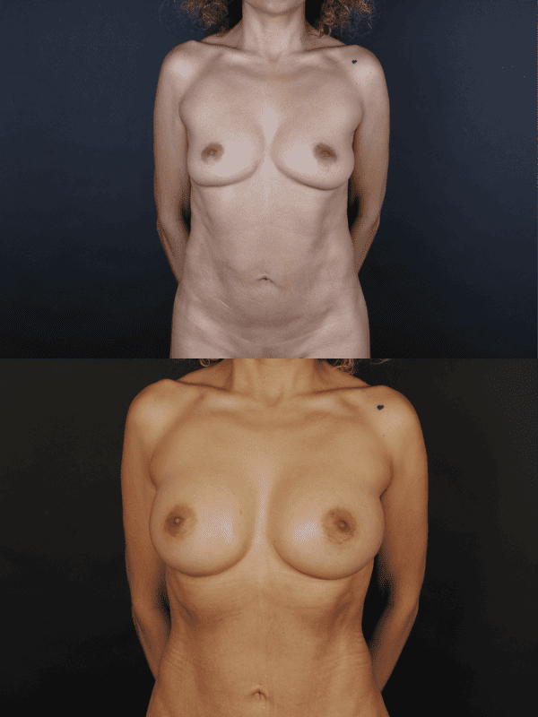 Minimal Scar