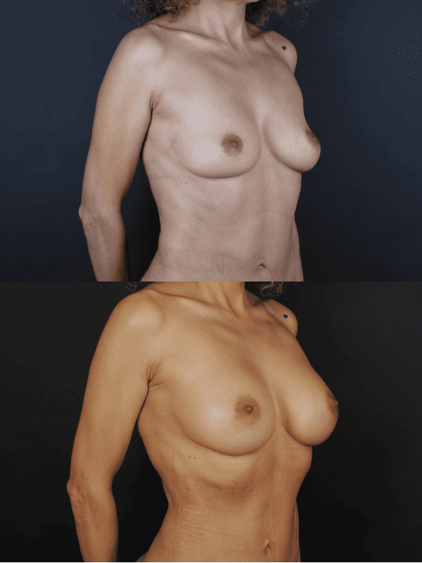 Minimal Scar