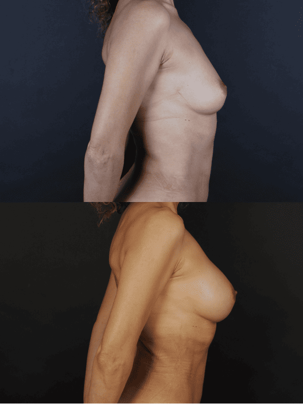 Minimal Scar