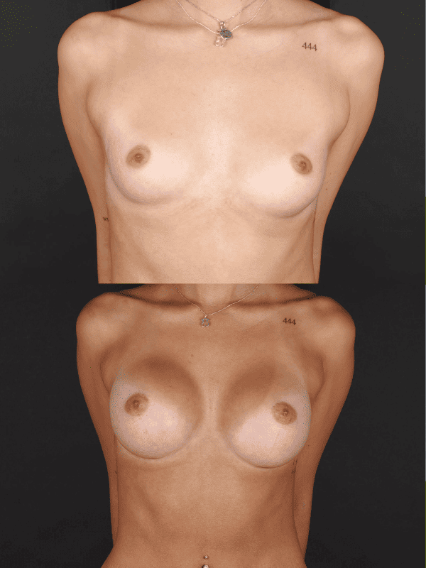 Minimal Scar