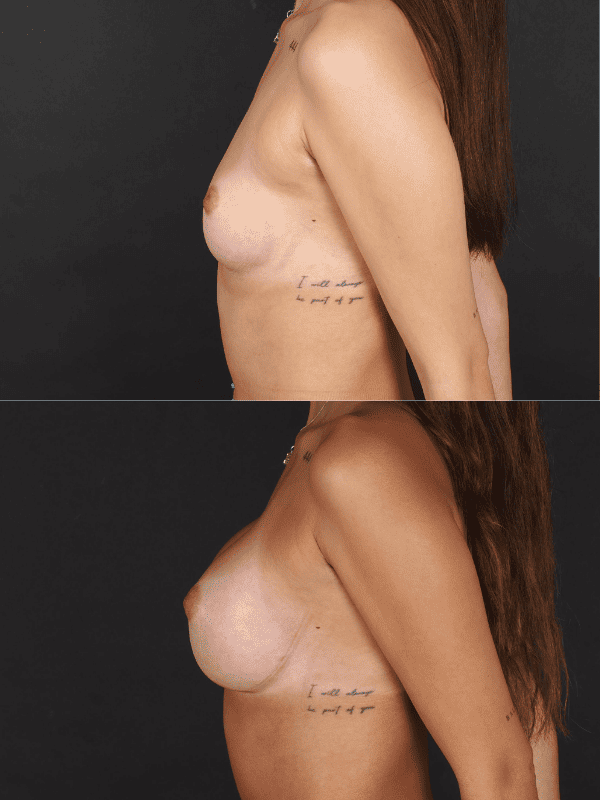 Minimal Scar
