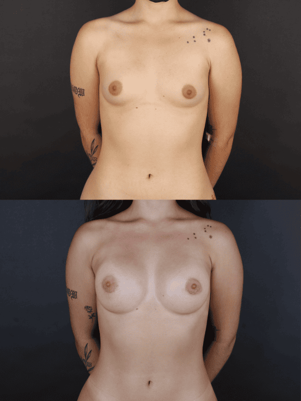 Minimal Scar