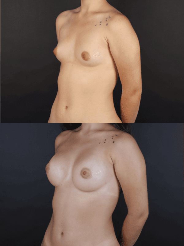 Minimal Scar