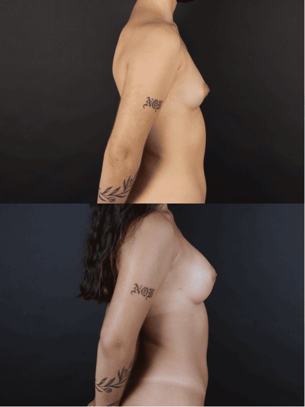 Minimal Scar