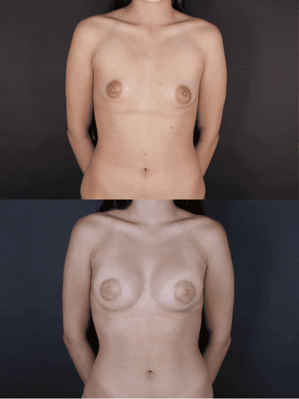 Minimal Scar