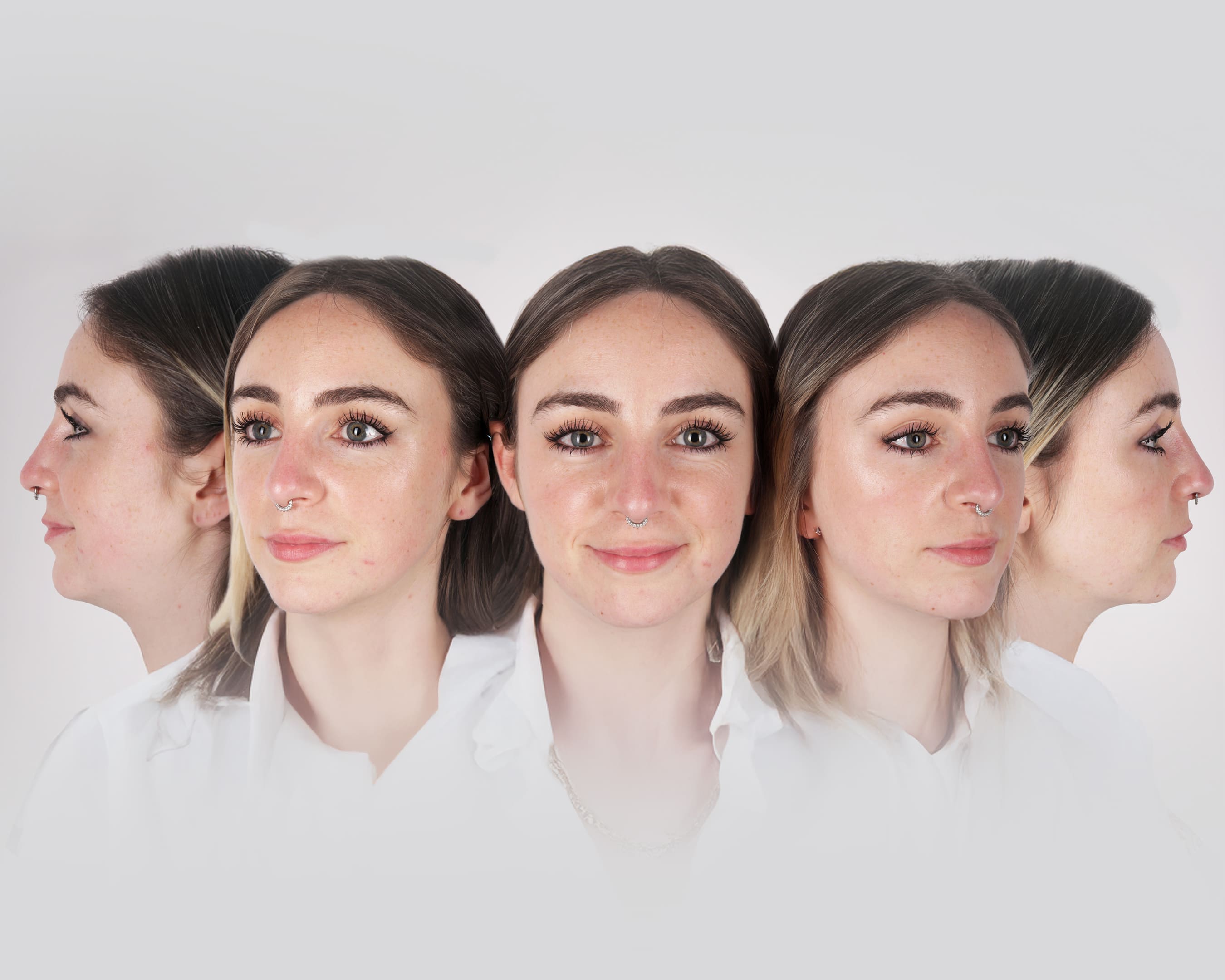Rinoplastia Ultrasónica