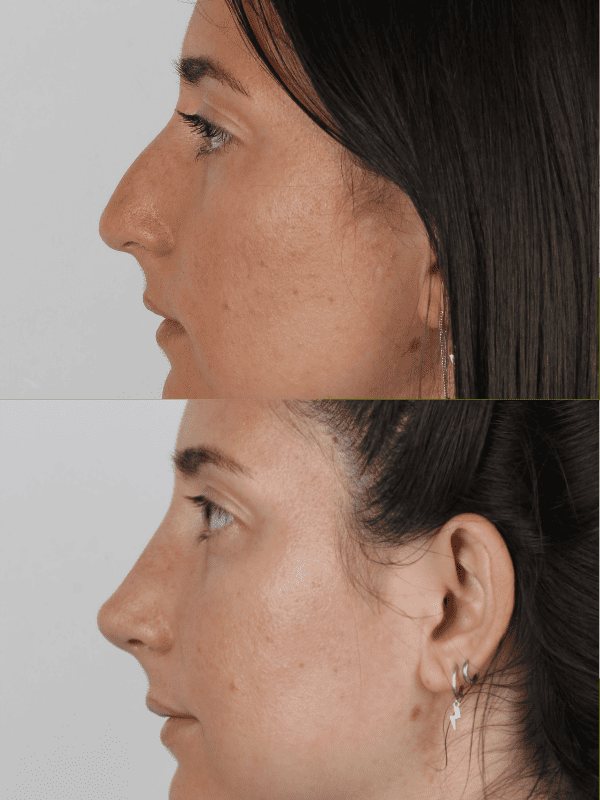 Rinoplastia Ultrasónica