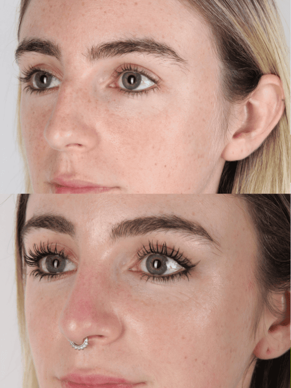Rinoplastia Ultrasónica
