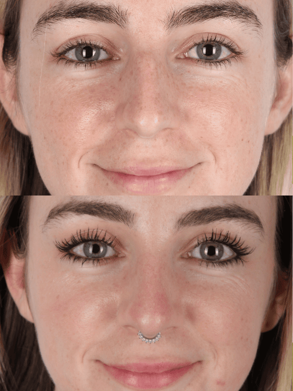 Rinoplastia Ultrasónica