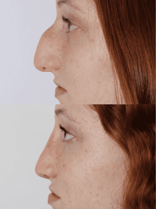 Rinoplastia Ultrasónica