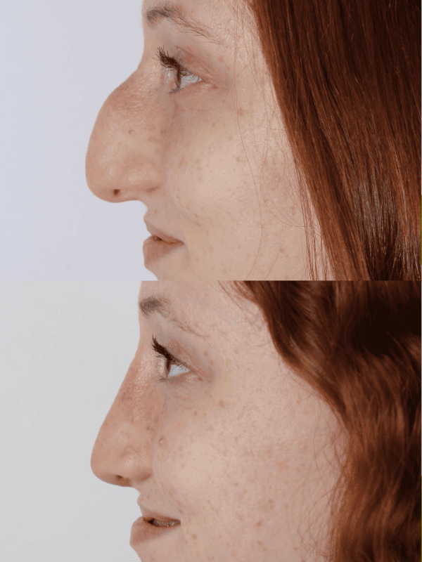 Rinoplastia Ultrasónica