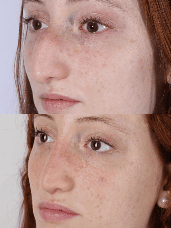Rinoplastia Ultrasónica